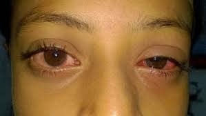 রাজশাহীতে ঘরে ঘরে দেখা দিচ্ছে চোখওঠা রোগ